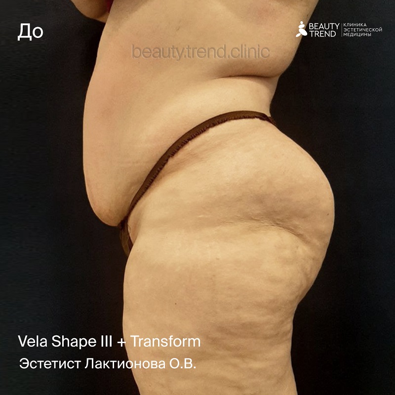Курс процедур для тела Vela Shape, Transform - до